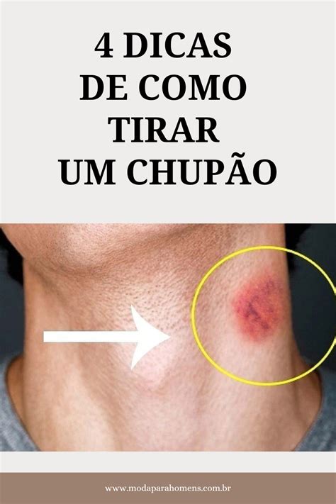 como tirar um chupao|Como Se Livrar de Um Chupão Da Noite pro Dia: 9 Passos